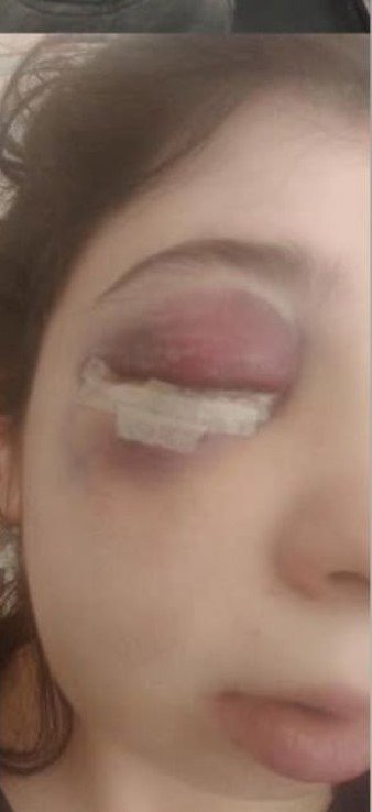 Sokak ortasında darbedildi... Artık yüzümün sol tarafını hissetmiyorum