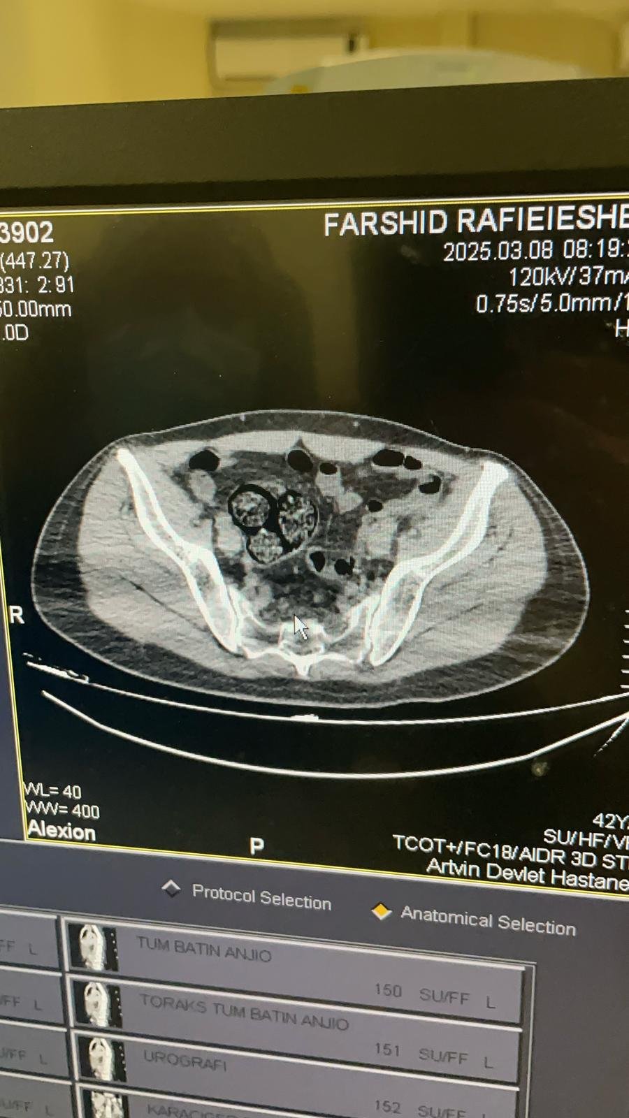 Bağırsağından uyuşturucu çıktı!