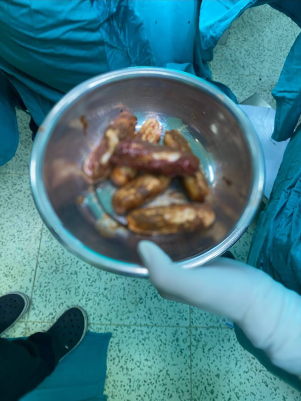 Bağırsağından uyuşturucu çıktı!