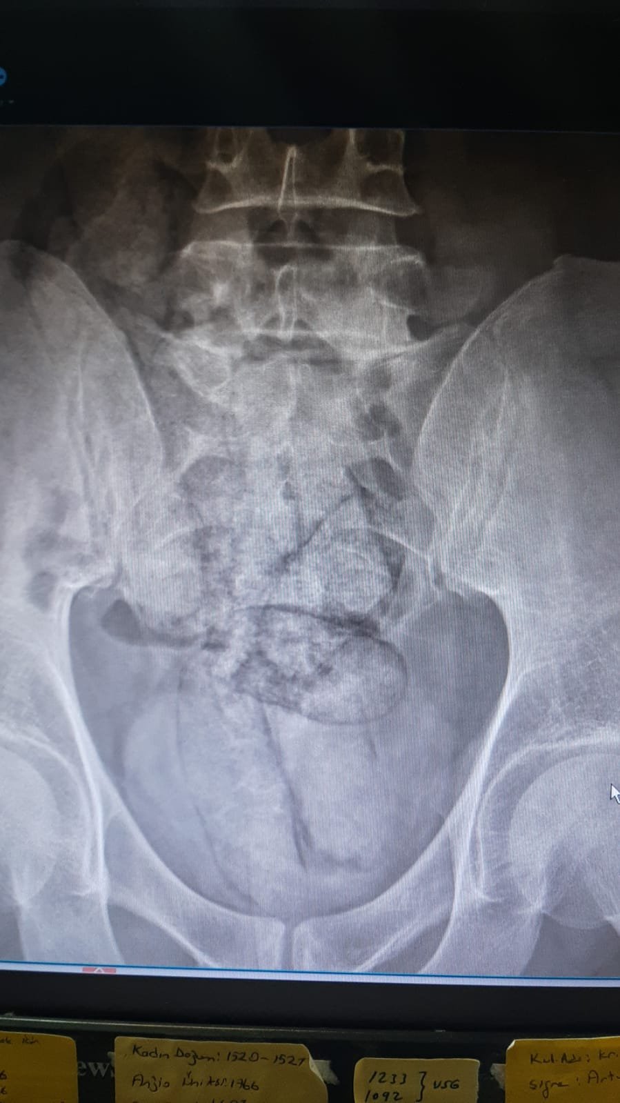 Bağırsağından uyuşturucu çıktı!