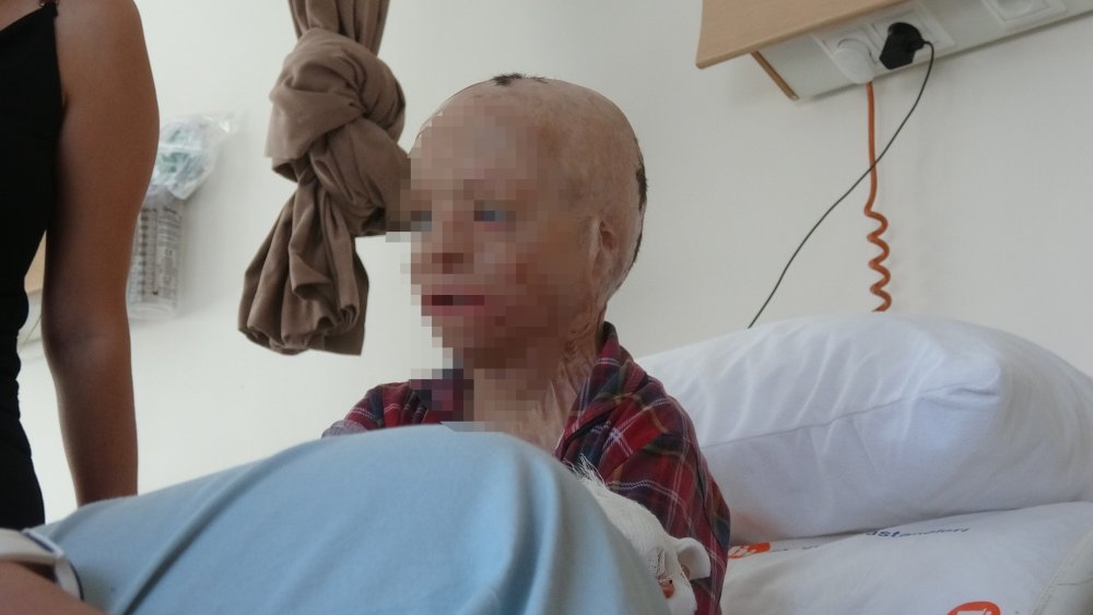 Babası ve 3 kardeşinin öldüğü yangında yaralanan Eymen'e Konya şifa oldu