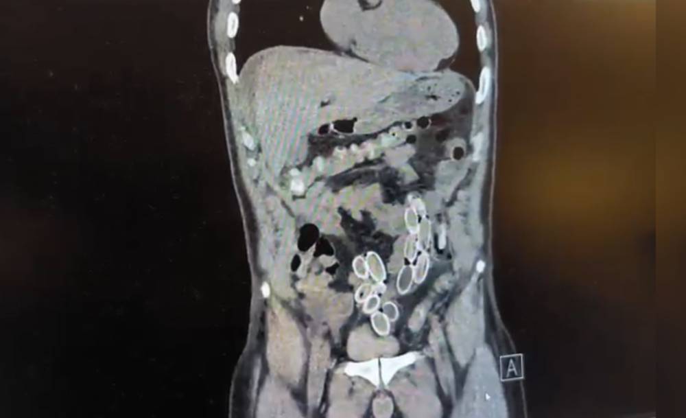 Midesinde uyuşturucu getirdi; ameliyatla çıkarıldı